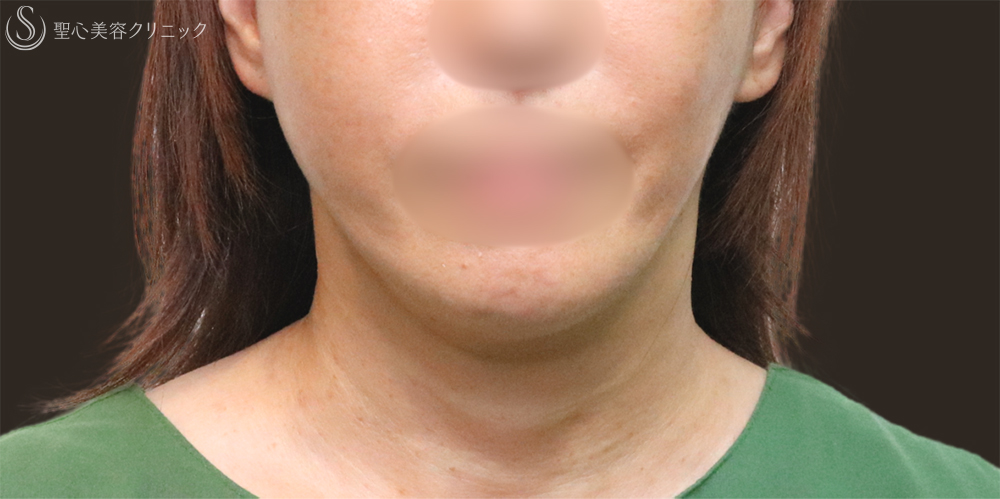 【60代女性・フェイスラインをすっきり】フェイスリフト＋脂肪吸引（頬＋顎下）＋リガメント処理（3ヶ月後） After 名古屋+フェイスリフト　たるみ　脂肪吸引　若返り