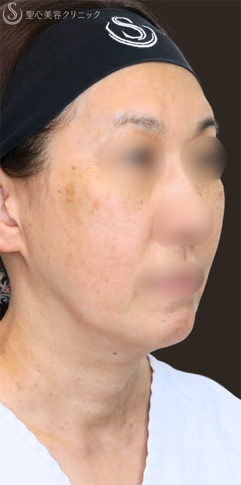 【60代女性・フェイスラインをすっきり】フェイスリフト＋脂肪吸引（頬＋顎下）＋リガメント処理（3ヶ月後） Before 名古屋+フェイスリフト　たるみ　脂肪吸引　若返り