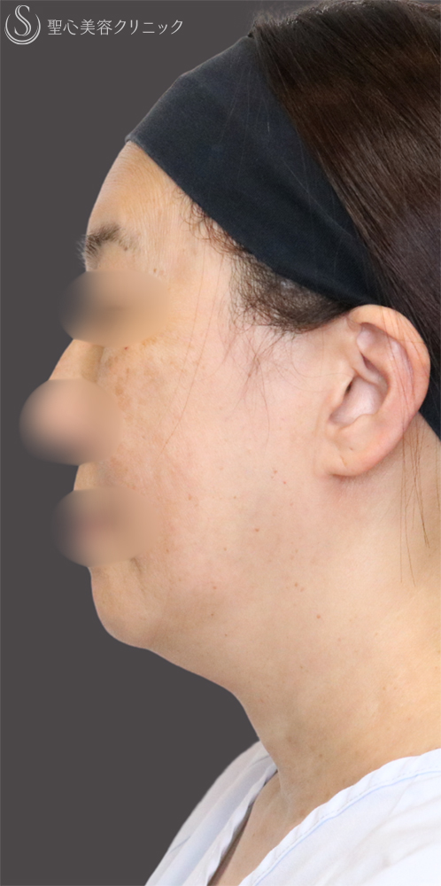 【60代女性・フェイスラインをすっきり】フェイスリフト＋脂肪吸引（頬＋顎下）＋リガメント処理（3ヶ月後） Before 名古屋+フェイスリフト　たるみ　脂肪吸引　若返り