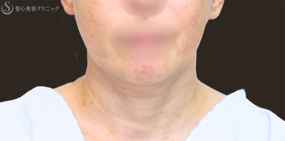 【60代女性・フェイスラインをすっきり】フェイスリフト＋脂肪吸引（頬＋顎下）＋リガメント処理（3ヶ月後） Before 名古屋+フェイスリフト　たるみ　脂肪吸引　若返り