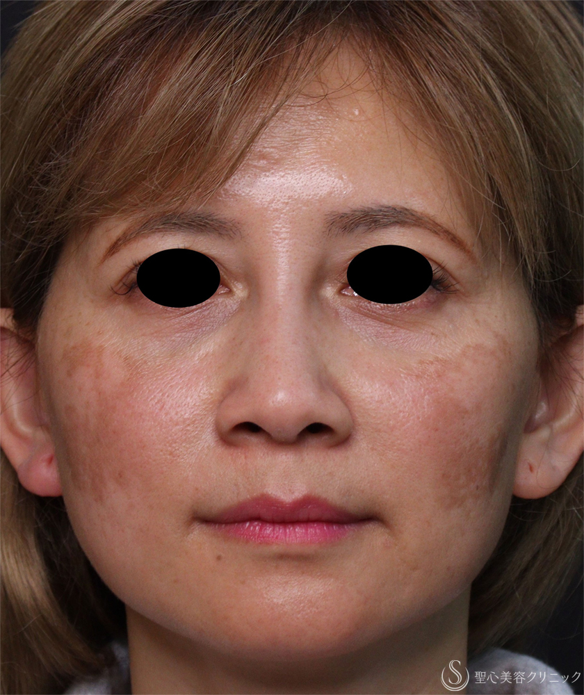 【40代女性・鼻の形】小鼻縮小術（1ヶ月後） Before 