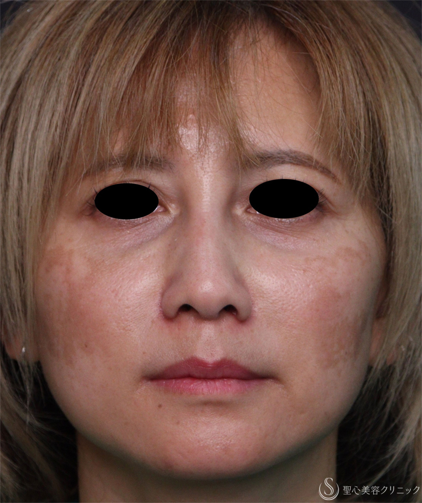 【40代女性・鼻の形】小鼻縮小術（1ヶ月後） After 