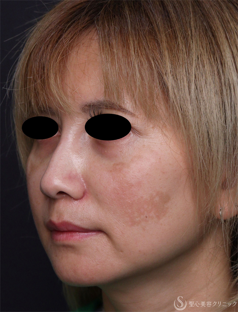 【40代女性・鼻の形】小鼻縮小術（1ヶ月後） After 