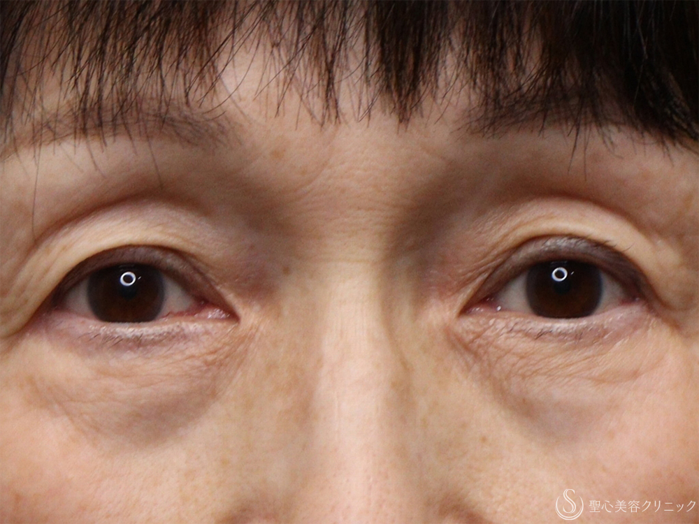 【60代女性・目の下を注射で若返り】ヒアルロン酸注射（1ヶ月後） Before 