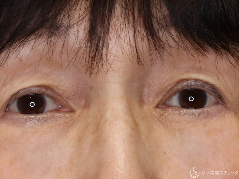 【60代女性・目の下を注射で若返り】ヒアルロン酸注射（1ヶ月後） After 