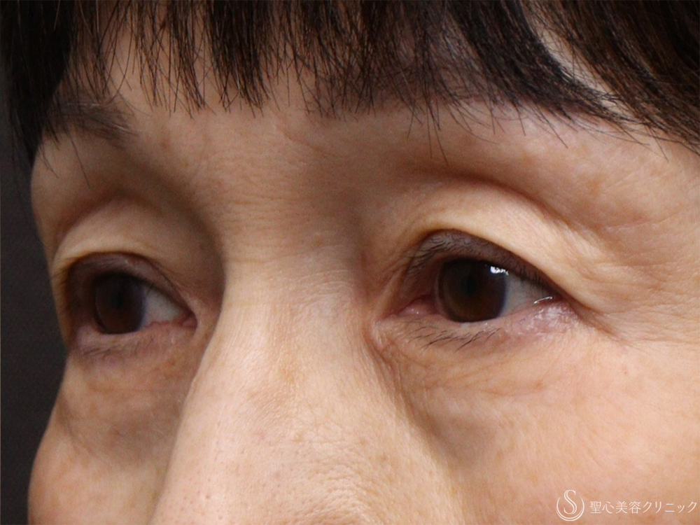 【60代女性・目の下を注射で若返り】ヒアルロン酸注射（1ヶ月後） Before 