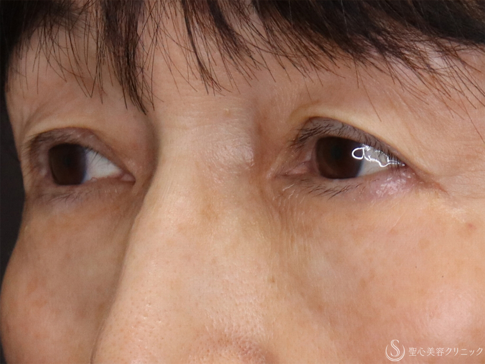 【60代女性・目の下を注射で若返り】ヒアルロン酸注射（1ヶ月後） After 