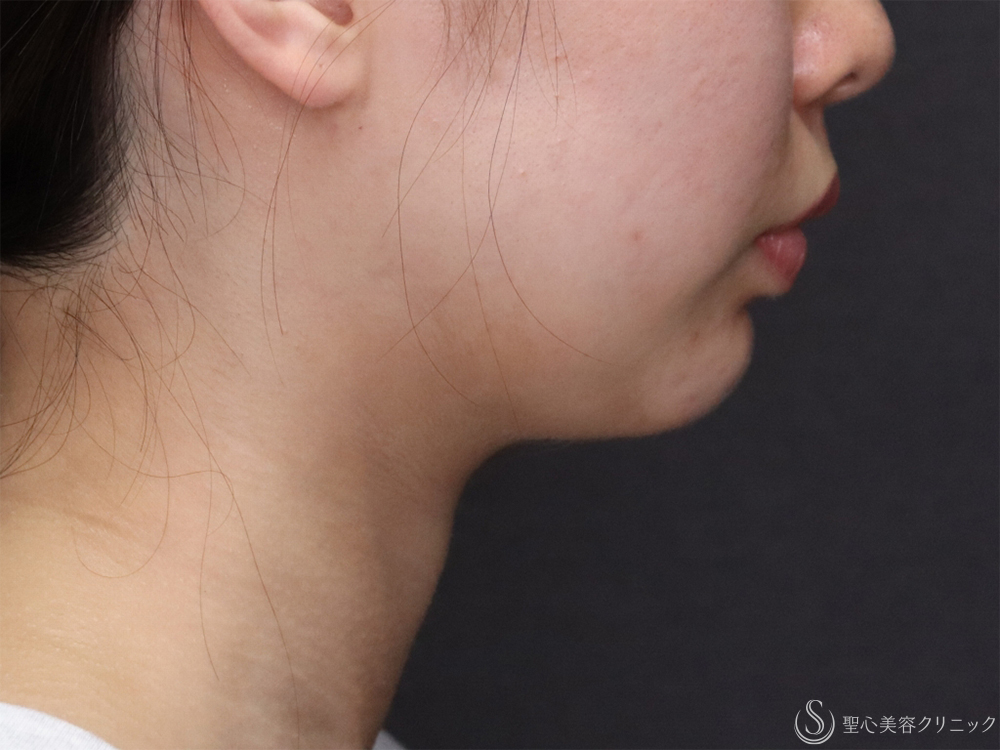 【20代女性・フェイスラインをすっきり】顎下脂肪吸引注射（3ヶ月後） After 