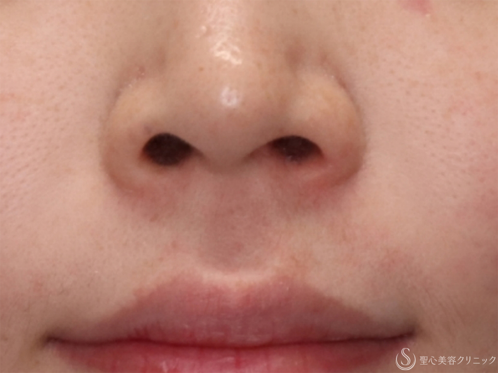 【20代女性・自然に鼻を小さく】小鼻縮小（内側法）（3ヶ月後） Before 