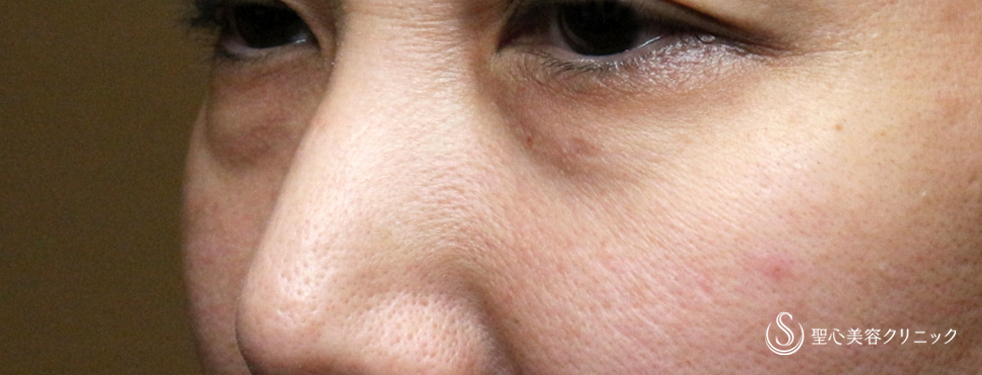 【40代女性・この「目の下のクマ」どう治す？】表ハムラ+α法「Ver.3」 単独例（7日後〜6ヶ月後） Before 
