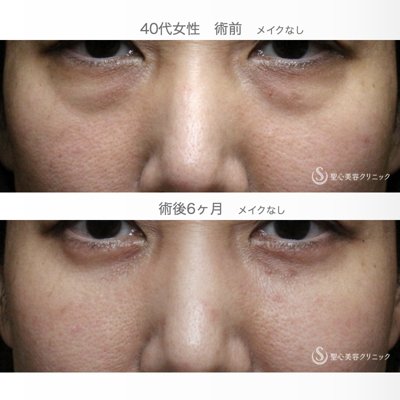 【40代女性・この「目の下のクマ」どう治す？】表ハムラ+α法「Ver.3」 単独例（7日後〜6ヶ月後） After 