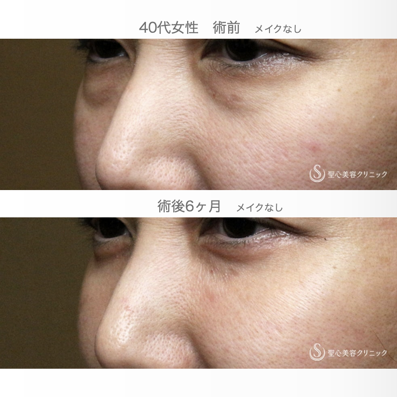 【40代女性・この「目の下のクマ」どう治す？】表ハムラ+α法「Ver.3」 単独例（7日後〜6ヶ月後） After 