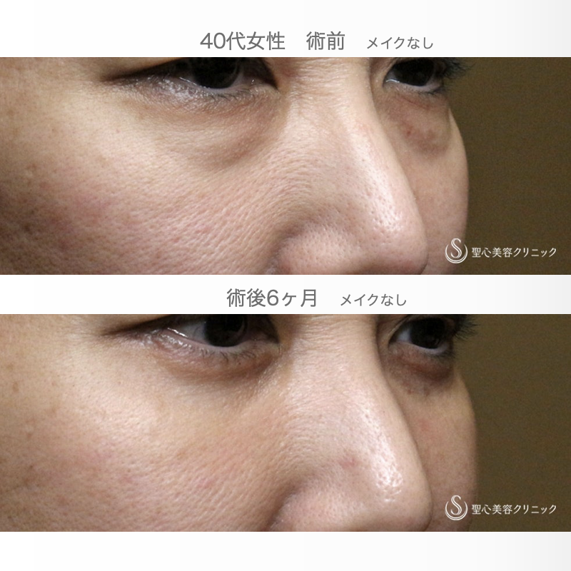 【40代女性・この「目の下のクマ」どう治す？】表ハムラ+α法「Ver.3」 単独例（7日後〜6ヶ月後） After 
