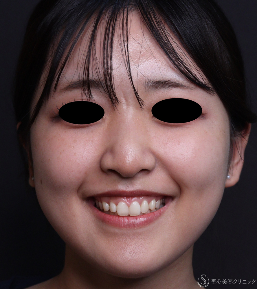 【20代女性・ガミースマイル】ボツリヌストキシン注射（10日後） Before 