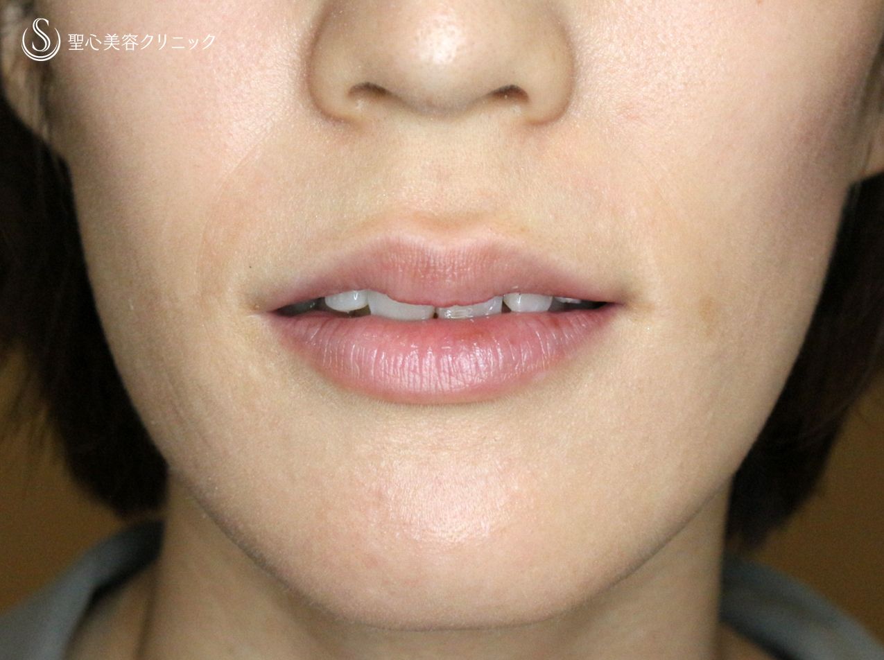 【30代女性・グラマラスな唇に】スマイルリップ注入法（処置直後） Before 