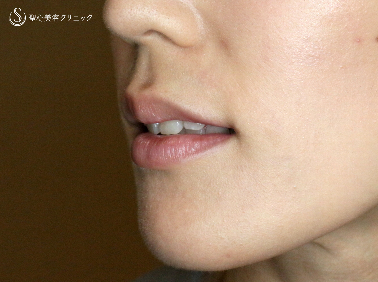 【30代女性・グラマラスな唇に】スマイルリップ注入法（処置直後） Before 