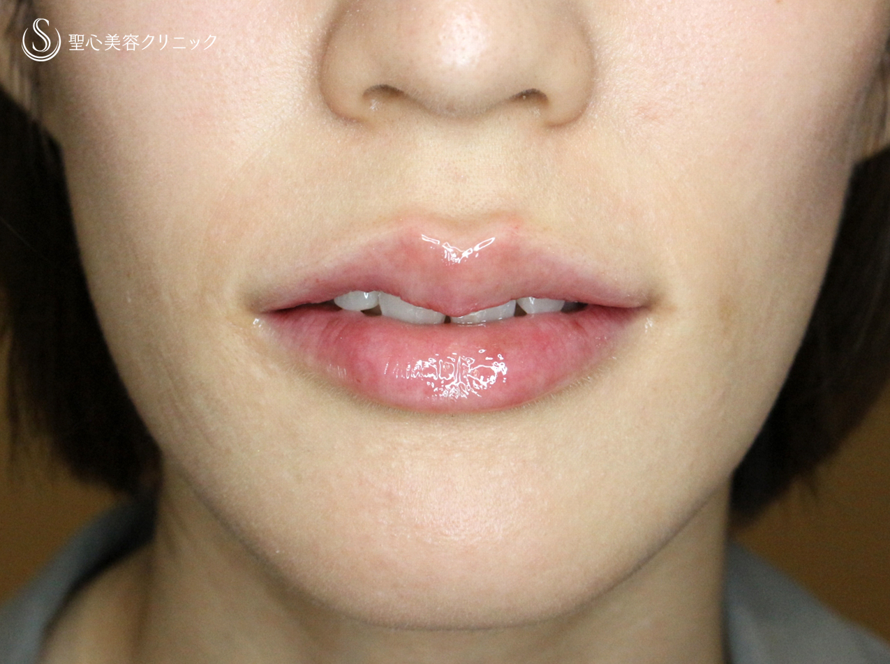 【30代女性・グラマラスな唇に】スマイルリップ注入法（処置直後） After 