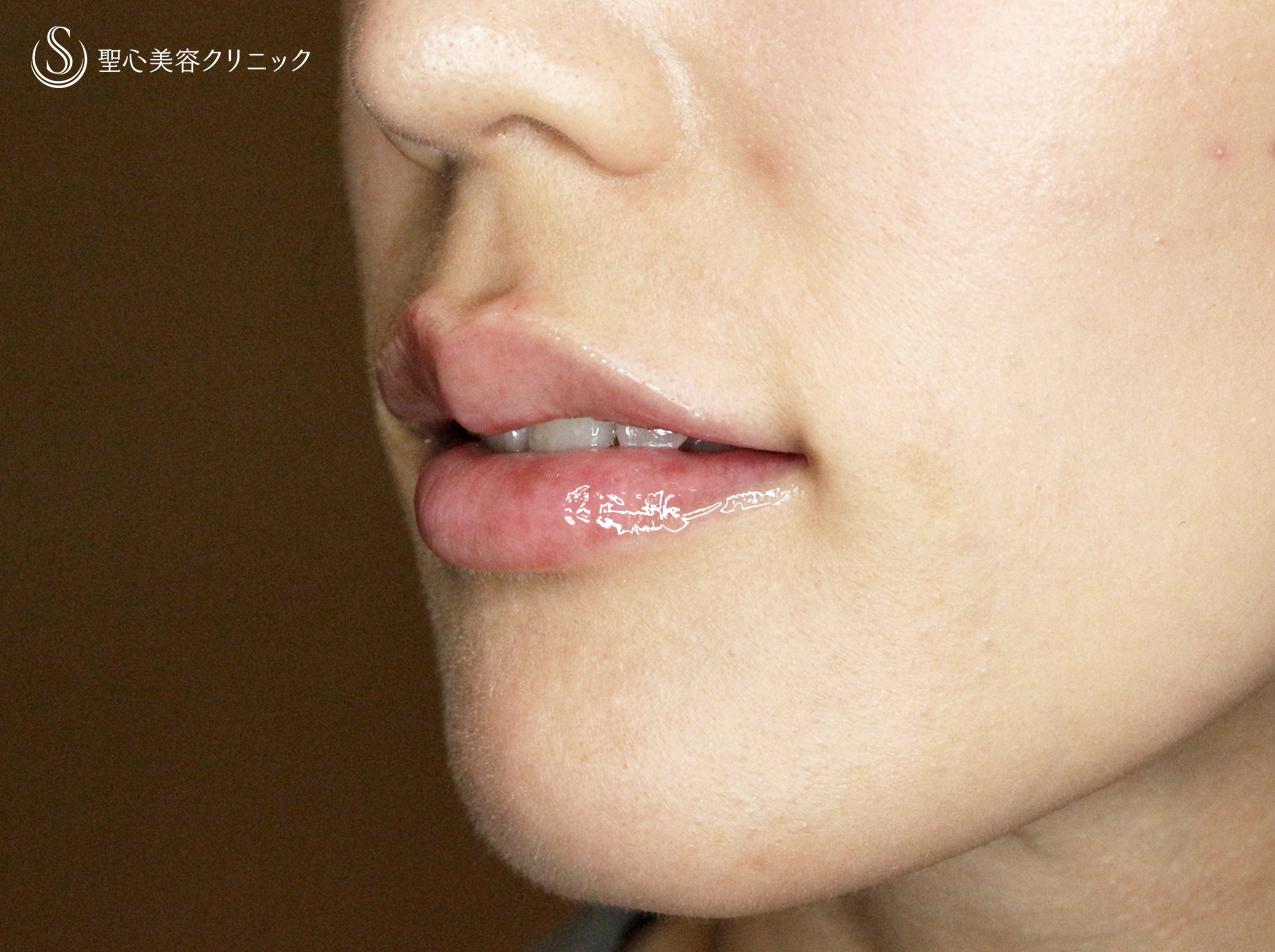 【30代女性・グラマラスな唇に】スマイルリップ注入法（処置直後） After 