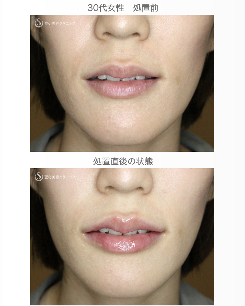 【30代女性・グラマラスな唇に】スマイルリップ注入法（処置直後） After 