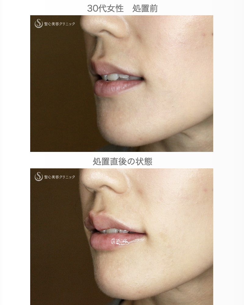 【30代女性・グラマラスな唇に】スマイルリップ注入法（処置直後） After 