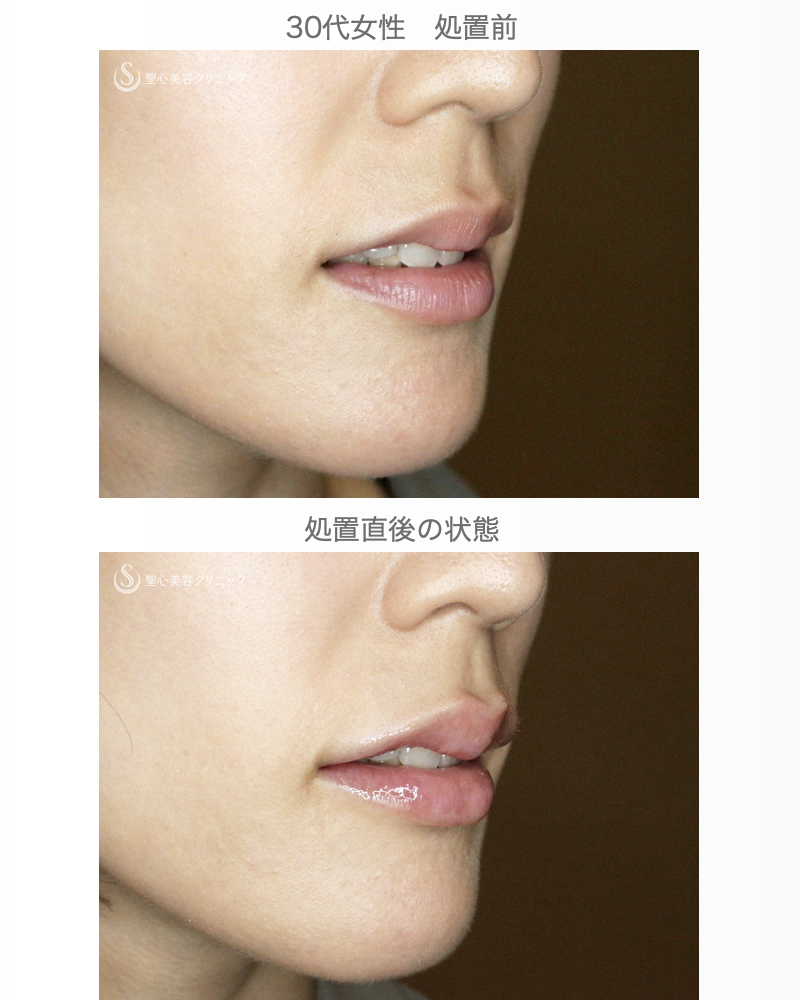 【30代女性・グラマラスな唇に】スマイルリップ注入法（処置直後） After 