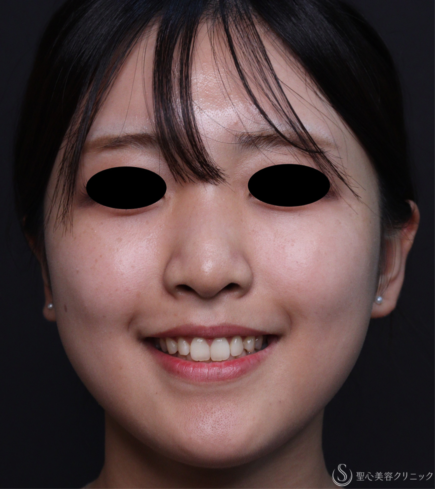【20代女性・ガミースマイル】ボツリヌストキシン注射（10日後） After 