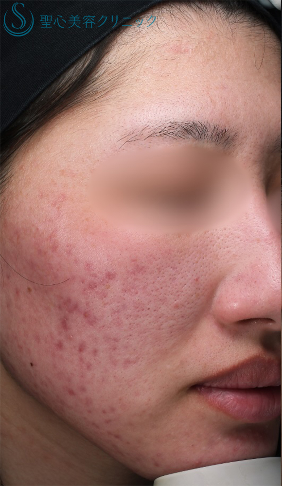 【20代女性・顔の赤み】585 Quanta System Q1（2回処置後） Before 