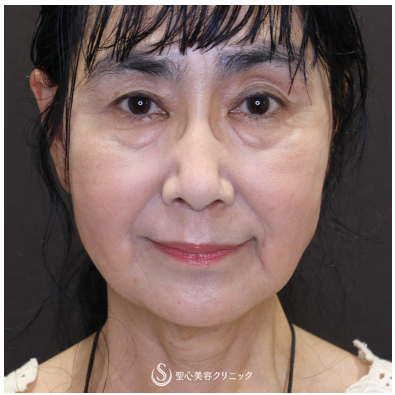 【60代女性・スレッドリフトの組み合わせで自然な若返り】フィオラEST-FL＋アンカーMAX（術後3ヶ月） After 