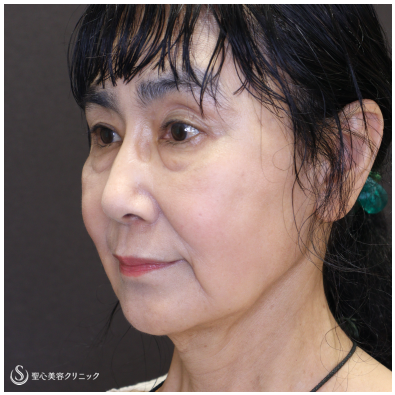 【60代女性・スレッドリフトの組み合わせで自然な若返り】フィオラEST-FL＋アンカーMAX（術後3ヶ月） After 