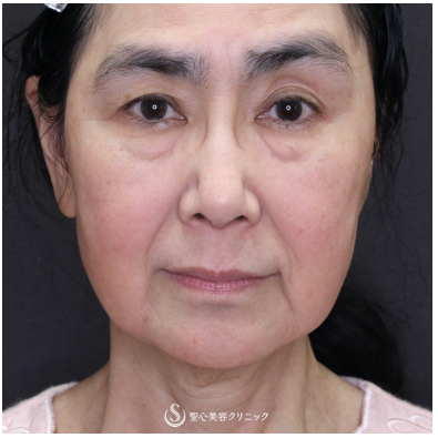 【60代女性・スレッドリフトの組み合わせで自然な若返り】フィオラEST-FL＋アンカーMAX（術後3ヶ月） Before 