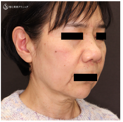 【60代女性・スレッド（糸）でリフトアップ】TESSリフト（術直後） Before 