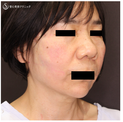【60代女性・スレッド（糸）でリフトアップ】TESSリフト（術直後） After 