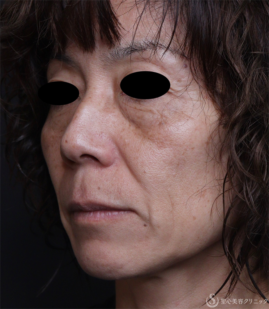 【50代女性・ほうれい線】レスチレンディファイン（1週間後） Before 