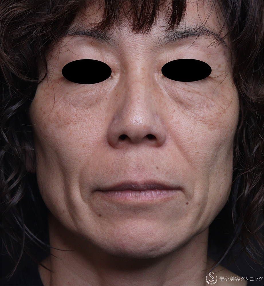 【50代女性・ほうれい線】レスチレンディファイン（1週間後） Before 