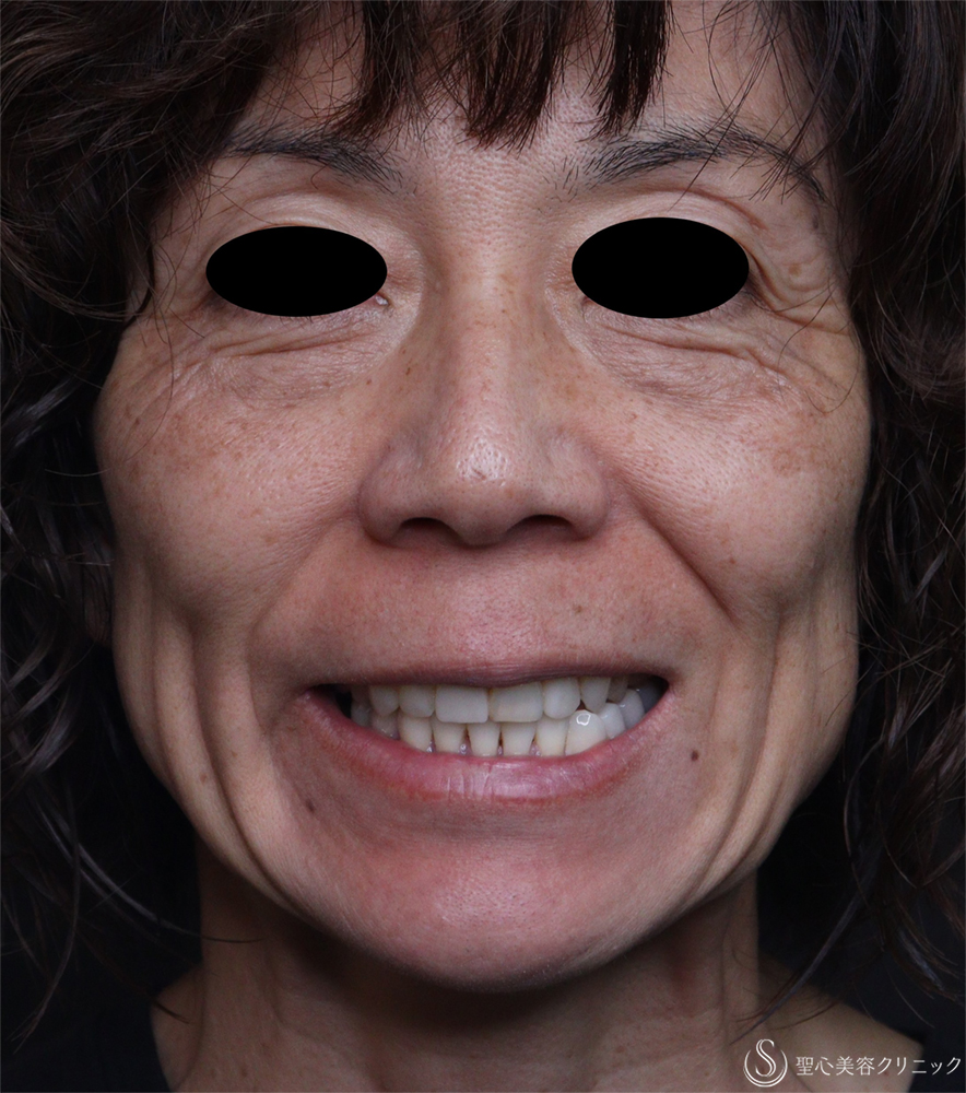 【50代女性・ほうれい線】レスチレンディファイン（1週間後） Before 