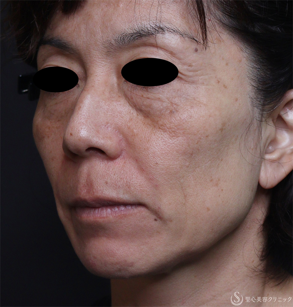 【50代女性・ほうれい線】レスチレンディファイン（1週間後） After 
