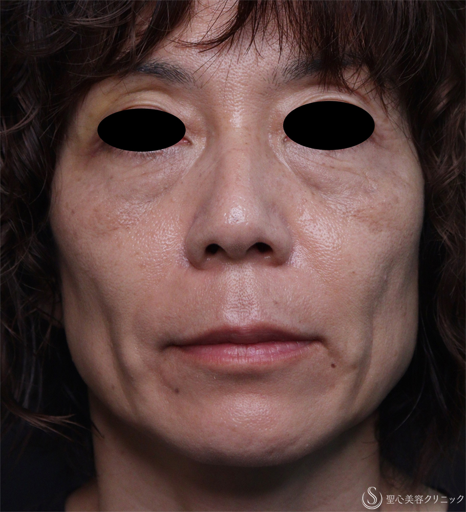 【50代女性・ほうれい線】レスチレンディファイン（1週間後） After 