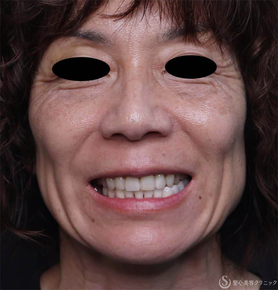 【50代女性・ほうれい線】レスチレンディファイン（1週間後） After 