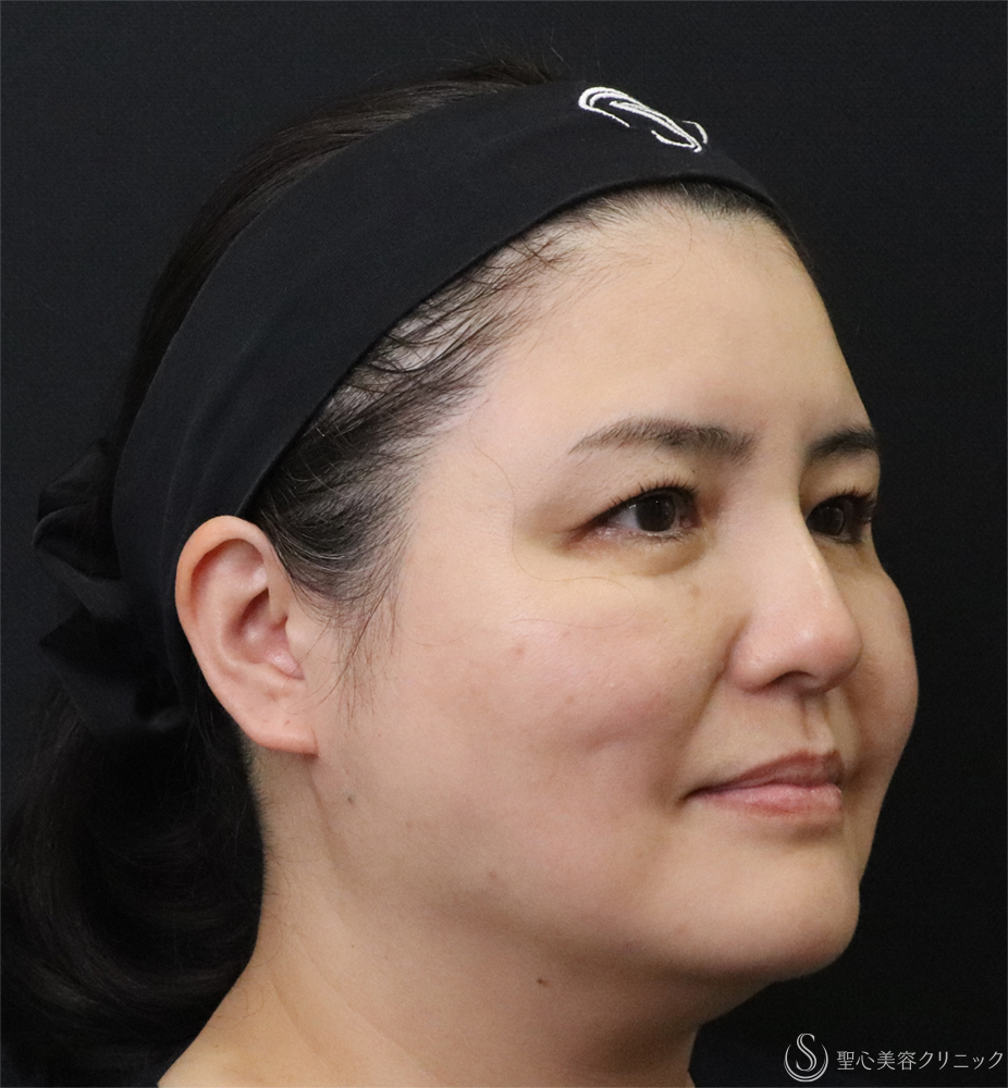 【40代女性・小顔に】最新HIFU テントリプル（3週間後） Before 