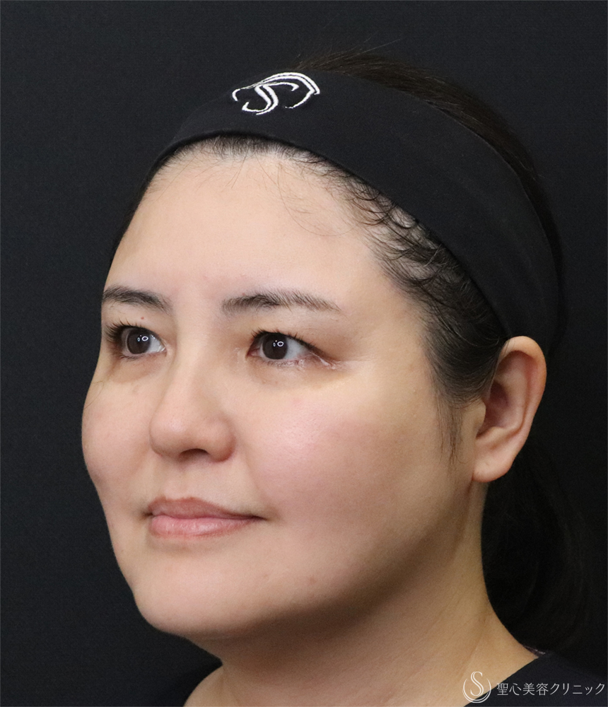 【40代女性・小顔に】最新HIFU テントリプル（3週間後） Before 