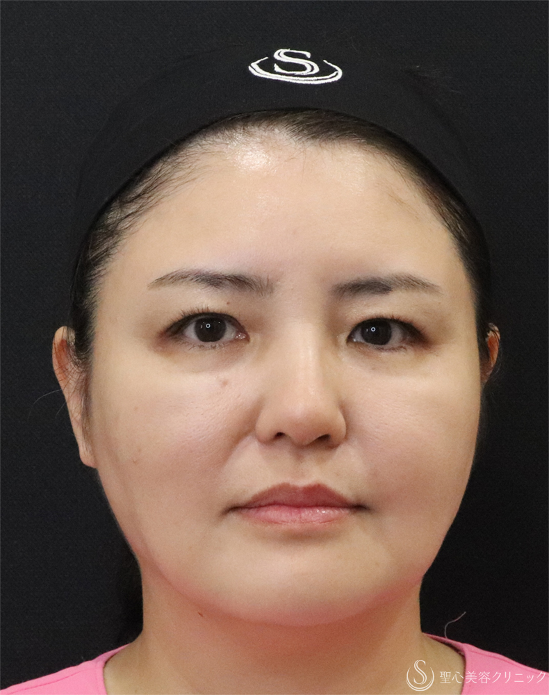 【40代女性・小顔に】最新HIFU テントリプル（3週間後） After 