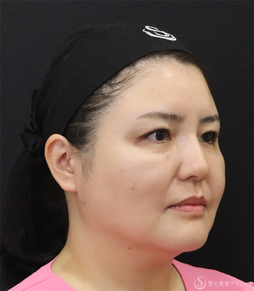 【40代女性・小顔に】最新HIFU テントリプル（3週間後） After 