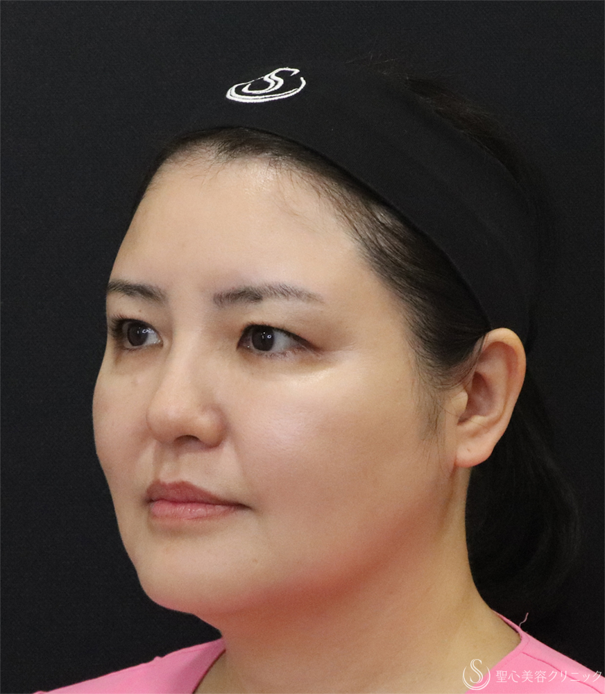 【40代女性・小顔に】最新HIFU テントリプル（3週間後） After 