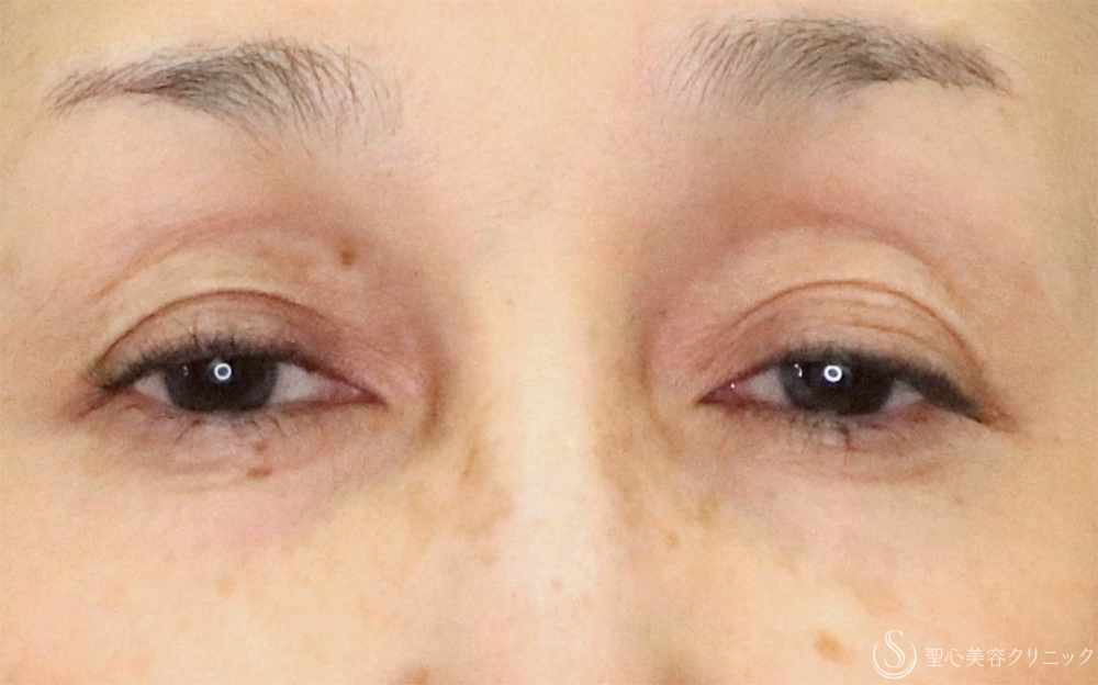【60代女性・優しい目元に】眼瞼下垂（1ヶ月後） Before 