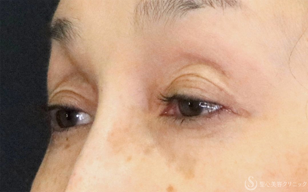 【60代女性・優しい目元に】眼瞼下垂（1ヶ月後） Before 