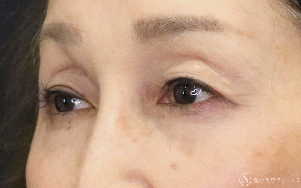 【60代女性・優しい目元に】眼瞼下垂（1ヶ月後） After 