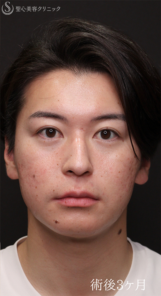 【20代男性・クマ施術で疲れみえを改善】裏ハムラ法（3ヶ月後） After 