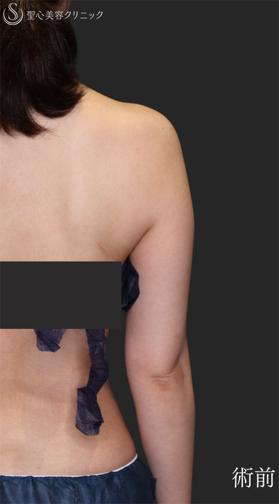 【30代女性・すらっとした二の腕に】脂肪吸引（上腕）（1ヶ月後） Before 