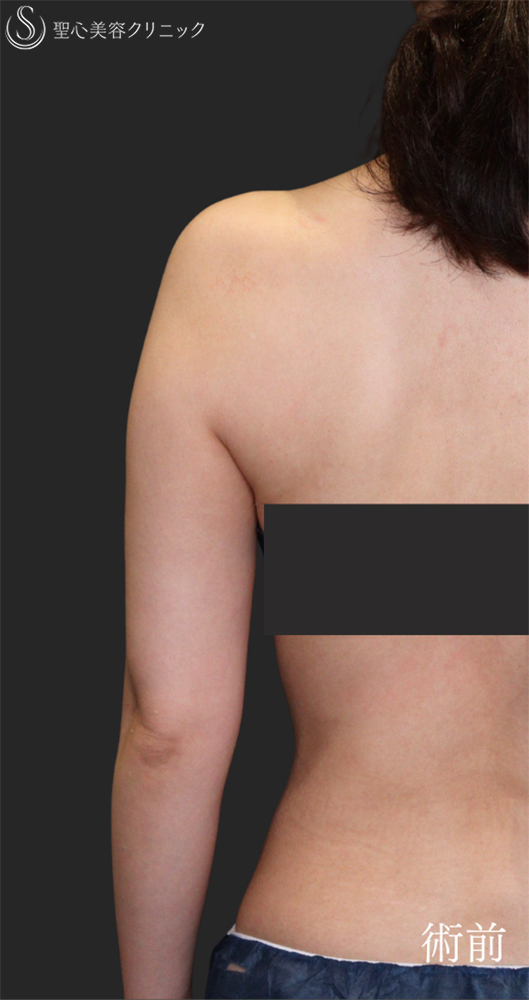 【30代女性・すらっとした二の腕に】脂肪吸引（上腕）（1ヶ月後） Before 