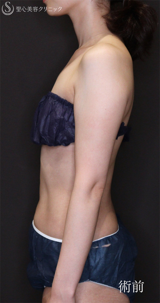 【30代女性・すらっとした二の腕に】脂肪吸引（上腕）（1ヶ月後） Before 